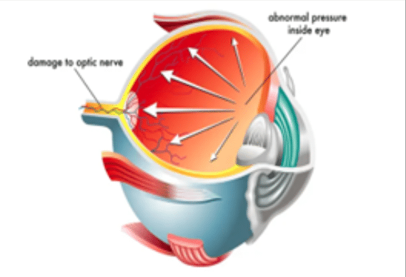 Glaucoma
