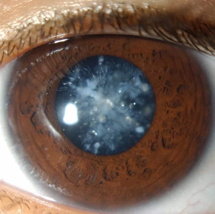 Cataracts